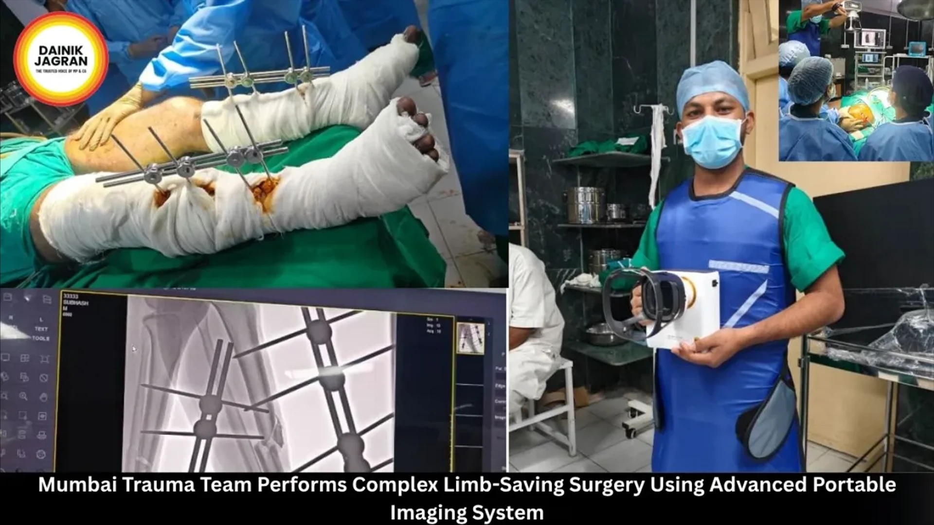 Mumbai Trauma Team Performs Limb-Saving Surgery with REMEX-KA6 news graphic image